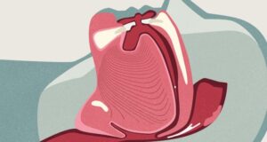 VIDEO: Sleep specialist has tips to recognize sleep apnea