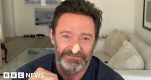 Hugh Jackman has new skin cancer scare, urges sun safety