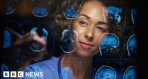 New Alzheimer’s drug slows disease by a third