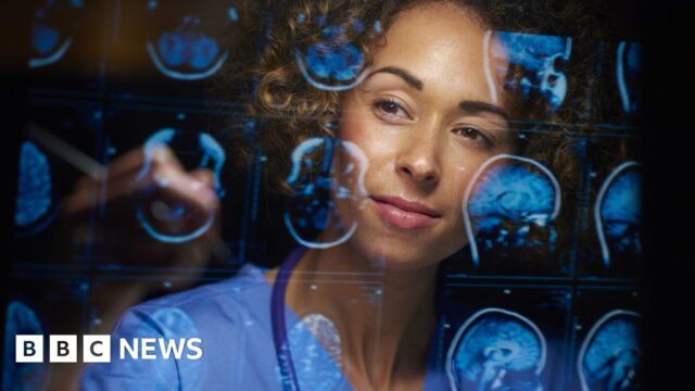 New Alzheimer’s drug slows disease by a third