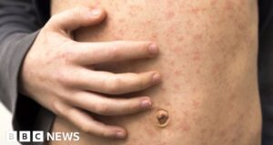 Rise in UK measles cases causing concern